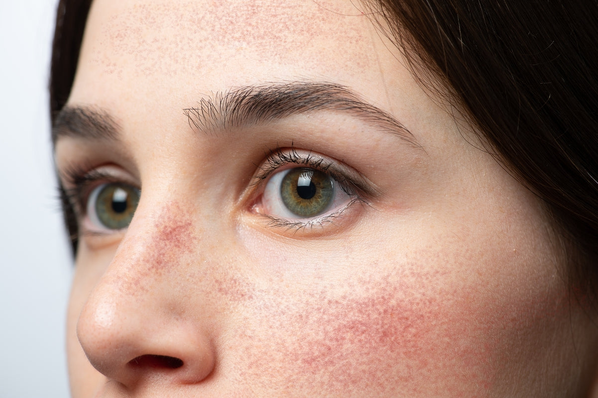 Rosacea-Prone Skin Care: Six Key Recommendations from the American Academy of Dermatology