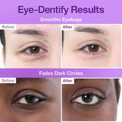 Before and after comparison of eye bags and dark circles treatment hydrating eye patches dark circles numbuzin NZ