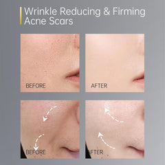Before and after effects of wrinkle reducing and firming acne scars treatment on skin-The Cosmetic Store NZ